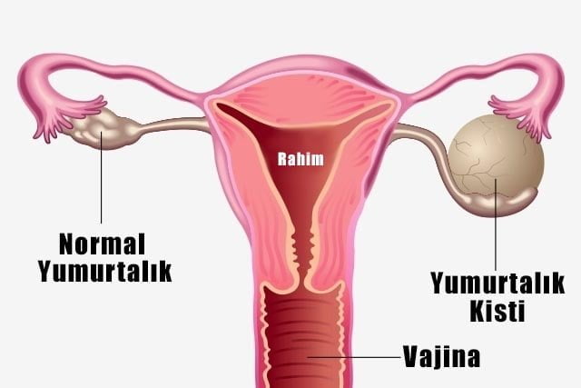 yumurtalık kisti