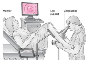 kolposkopi nedir?