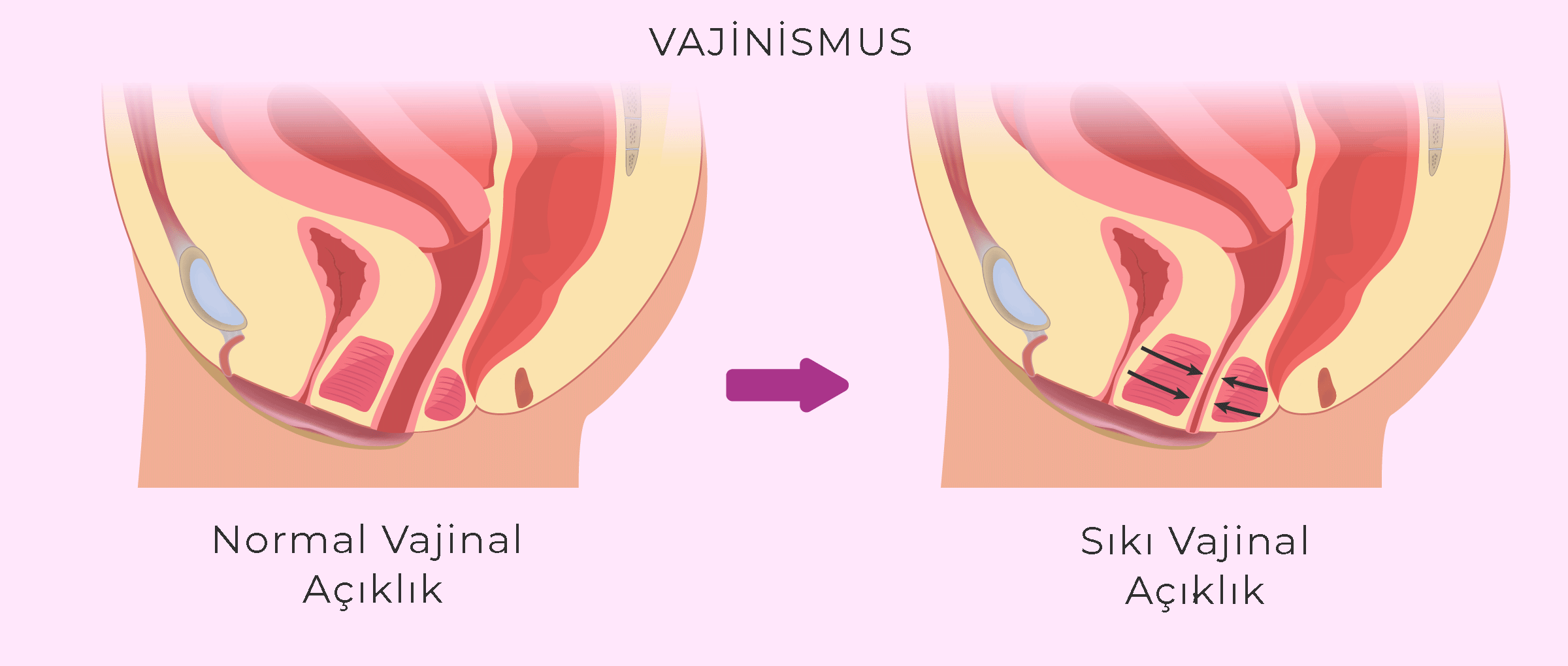 vajinismus