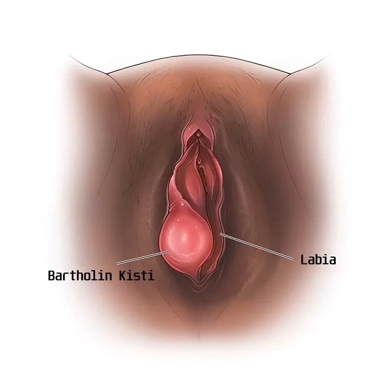 Bartholin kisti nedir