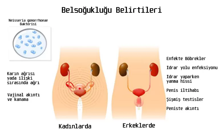 Bel soğukluğu belirtileri