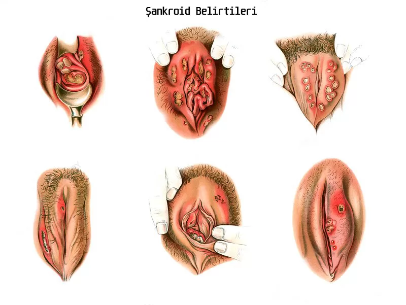 Şankroid görüntüleri