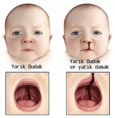 yarık dudak ve yarık damak