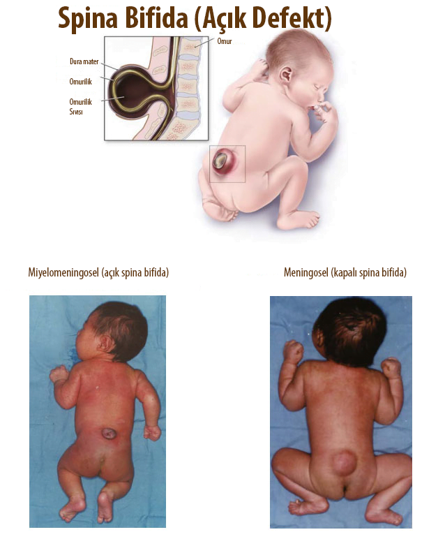 spina bifida nedir