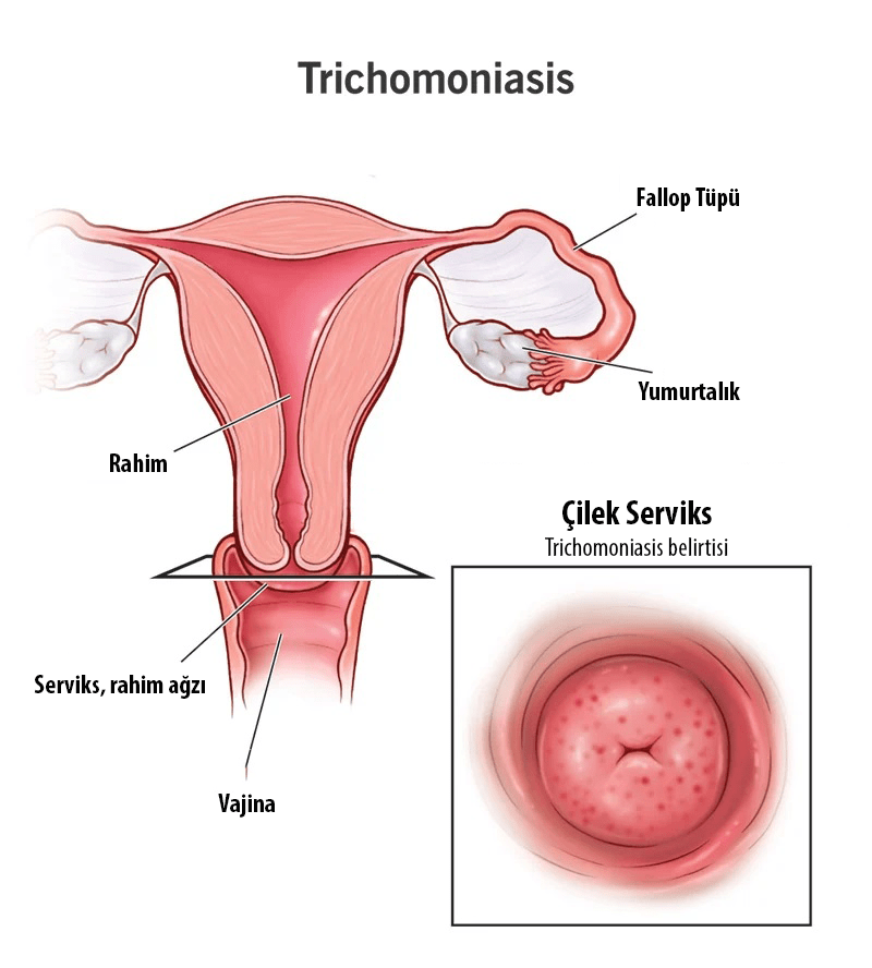 trichomoniasis belirtileri nelerdir